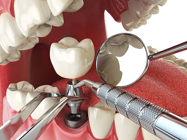 Best Emergency Wisdom Teeth Removal in Lockport, NY